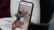 Phần mũi bị hoại tử của bệnh nhân - Ảnh: Báo Thanh niên