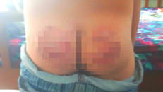 Kỷ luật thầy giáo đánh học sinh lớp 5 bầm tím ở An Giang