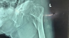 Nối các mảnh xương gãy cho cụ bà 101 tuổi