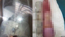 Dương vật giả kẹt sâu trong hậu môn, nam thanh niên nguy kịch