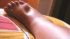 Đi bộ đau và sưng chân có thể mắc căn bệnh gây đột tử