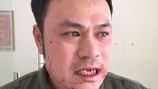 Nhân viên an ninh sân bay Nội Bài bị cò mồi taxi đánh gãy 4 răng