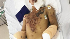 Bệnh nhân bị cụt hai tay do chế pháo nổ. Ảnh: Vnexpress