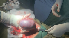 Cứu sống sản phụ mang khối u xoắn đang hoại tử