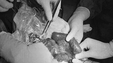 Bé trai 3 tuổi bị búi giun lớn làm tắc ruột