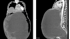 Bà cụ 78 tuổi mang khối u buồng trứng nặng 30kg