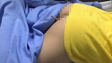 Nam sinh lớp 4 bị bút chì cắm vào mông sâu 16cm