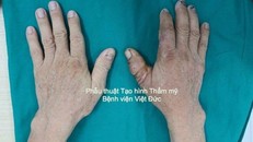 Phẫu thuật nối ngón tay cái đứt rời cho người đàn ông