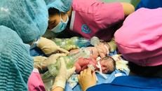 Cặp song sinh dính liền nhau, có chung hậu môn