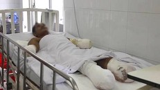 Bị điện cao thế giật, 2 công nhân phải cắt cụt tứ chi