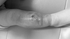 Bé trai nhập viện cấp cứu vì một nốt mụn nhỏ ở cẳng chân