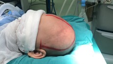 Phẫu thuật dị dạng hộp sọ cho bé 5 tháng tuổi