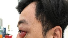 Lồi mắt sau 2 năm bị tai nạn giao thông, thanh niên suýt bị mù