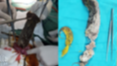 Tóc, bông gòn cuộn thành khối lớn trong bụng bé gái 5 tuổi