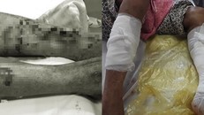 Cụ ông 93 tuổi bị chó nhà nuôi cắn nát 2 chân