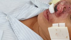 Bệnh ‘Vi khuẩn ăn thịt người’ nguy hiểm như thế nào?