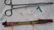 Bé trai 8 tuổi bị gốc cỏ đâm thủng bụng khi chơi đùa