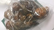 Lấy khối bã thức ăn chứa hạt xoài, quả chanh leo trong dạ dày người đàn ông