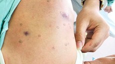 Người đàn ông suy thận vì bị đàn ong vò vẽ tấn công