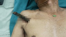 Cứu người đàn ông bị cây gỗ đâm xuyên phổi