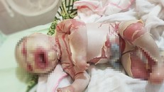 Bé sơ sinh đóng vảy như da cá vì bệnh cực hiếm