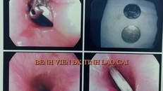 Hình ảnh 2 đồng xu mắc trong cổ họng bé 3 tuổi được gắp ra ngoài thành công - Ảnh: BVCC