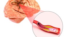 Đột quỵ não và vai trò của chụp cộng hưởng từ (MRI) trong tầm soát đột quỵ