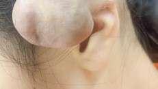 Xỏ khuyên, bấm nhiều lỗ trên vành tai dễ dẫn đến nhiều hệ luỵ