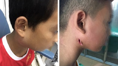 Người mắc Whitmore thường tiến triển nặng, tỷ lệ tử vong cao