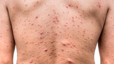 Khuyến cáo người dân phòng, chống bệnh thủy đậu