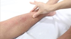 Triệu chứng lâm sàng của sốt xuất huyết, bệnh nhân sốt đến ngày 4-5 thường xuất hiện các ban đỏ dưới da. Ảnh: Minh Quyết/TTXVN