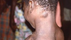 Bệnh nhân mắc đậu mùa khỉ tại CHDC Congo. Ảnh (tư liệu): Getty Images/TTXVN