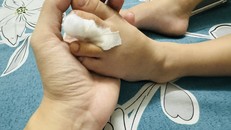 Xử trí đúng cách khi trẻ bị chấn thương ngón chân, ngón tay