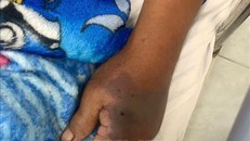 Tiêm 18 lọ huyết thanh cứu cụ ông bị rắn hổ đất cắn