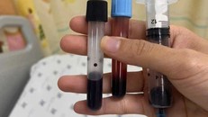 Mẫu máu xét nghiệm chuyển màu nâu đen của bé.