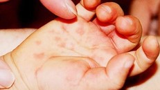 Giám sát, phát hiện sớm ổ dịch thủy đậu, không để lây lan trong cộng đồng