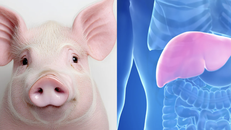 Gan lợn biến đổi gene mở ra hướng đi mới trong điều trị suy gan cấp
