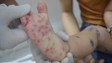 Các nốt phát ban của bệnh nhi bị tay chân miệng.