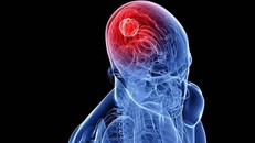 Xét nghiệm di truyền xác định loại khối u não trong chưa đầy 2 giờ
