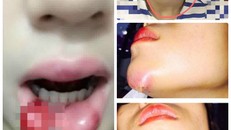 Chuộng thẩm mỹ nhiều thiếu nữ ở Hà Nội biến dạng sau một đêm