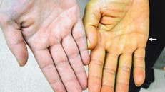 6 dấu hiệu nguy hiểm cảnh báo bệnh gan bạn nên biết