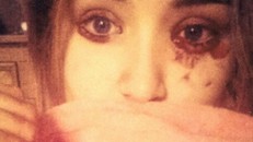 Mắc bệnh lạ cô gái chảy máu mắt 5 lần một ngày