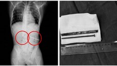 Người đàn ông liều lĩnh nuốt chửng đinh và răng cưa để nhận thưởng