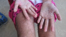 Bé gái bị bỏng rộp toàn thân, suýt chết vì uống nước ngọt?