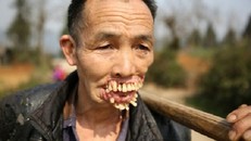 Kinh hãi khuôn mặt người đàn ông biến dạng vì chó sói cắn