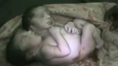 Xót xa số phận ngắn ngủi của bé sơ sinh hai đầu ở Ấn Độ