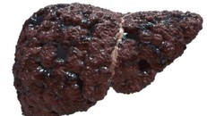 Nhiều người Việt gan cứng như đá vì hàng ngày nạp thứ đáng sợ này