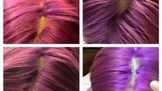 Rùng mình cô gái nhuộm tóc bị 'nổ da đầu' và tóc rụng từng mảng