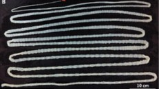 Kinh hoàng phát hiện con sán dài hơn 6m trong bụng người đàn ông