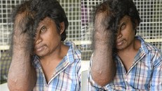 Bi kịch của người đàn ông có phần đầu rớt tận xuống ngực